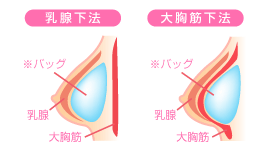 人口乳腺法